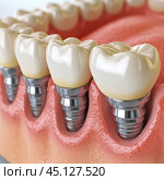 Dental implants installed in a row on the gum. The implants are made of metal and covered with crowns that look like natural teeth. The image shows the high quality of dental prostheses and careful work with gums and teeth. This image is ideal for use in medical and dental materials, as it illustrates modern methods of dental restoration. Стоковое AI-изображение, AI-художник Анна Кривицкая / Фотобанк Лори