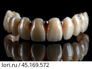 Dental bridge made with metal elements on a black background. The teeth look artificial, smooth and shiny, indicating dental restoration or prosthetics. Metal fastenings between the teeth emphasize the use of advanced dental technology. The black background adds contrast, focusing attention on the details of the dental bridge design. Стоковое AI-изображение, AI-художник Анна Кривицкая / Фотобанк Лори