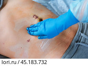 Hands of medic or nurse in blue gloves examining a fresh suture on a male stomach after laparoscopy surgical removal of appendicitis. Doctor examines of the patient. Man belly with medical stitches. Стоковое фото, фотограф Марина Демидюк / Фотобанк Лори