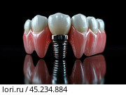 Visualization of a dental implant with an artificial crown installed in a modeled jaw. The black background shows the structure of the implant connected to the gum and teeth, highlighting the details of the anatomy and dental technology. Such visualization is often used to illustrate dental procedures, medical education, or dental care materials. Стоковое AI-изображение, AI-художник Анна Кривицкая / Фотобанк Лори