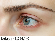 Human Eye with Conjunctivitis extreme close up. Closeup irritated infected red bloodshot eye. Female Eye. Vision. Eyesight. Young woman Eye Opening Wide. Viral infection with redness of eyeball. Macro. Стоковое AI-изображение, AI-художник Марина Демидюк / Фотобанк Лори