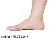 Human foot with hallux valgus. Стоковое фото, фотограф Дмитрий Киселёв / Фотобанк Лори