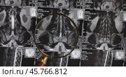 MRI lumbar spine background, magnetic resonance tomography. Doctor examines MRI of lumbar spine with pinched discs of spine and nerves. Стоковое видео, видеограф Андрей Армягов / Фотобанк Лори