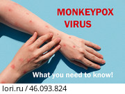 Phrase MONKEYPOX VIRUS what you need to know. Monkeypox new disease dangerous over the world. Patient with Monkey Pox. Painful rash, red spots blisters. Close up human hands with Health problem. Стоковое фото, фотограф Марина Демидюк / Фотобанк Лори