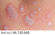 Fragment skin with chronic psoriasis vulgaris papules on male body. Genetic immune disease. Improvement after treatment. Стоковое AI-изображение, AI-художник Ирина Старикова / Фотобанк Лори