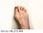 Подногтевая гематома через 6 месяцев после травмы ноги тесной обувью. Skier’s Toe is characterised by bleeding under the nail bed. The medical term for a Skier’s Toe is a Subungual Haematoma. Subungual hematoma 6 months after a leg injury from tight shoes. The effect of wearing uncomfortable shoes. Pedicure and podiatry. Medicine concept foot isolated on white. Стоковое фото, фотограф Iva Noel / Фотобанк Лори