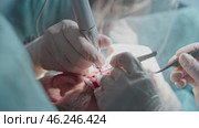 Surgeon Harvesting Hair Follicle from Patient. Hair Transplant. Fue method. Редакционное видео, видеограф Михаил Матвеев / Фотобанк Лори