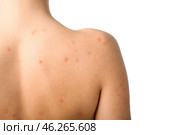 Girl with acne problem on white background. Стоковое фото, фотограф Pixel_shot / Фотобанк Лори