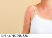 Woman with red sunburned skin against color background, closeup. Стоковое фото, фотограф Pixel_shot / Фотобанк Лори