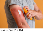Man with red sunburned skin applying cream against color background, closeup. Стоковое фото, фотограф Pixel_shot / Фотобанк Лори