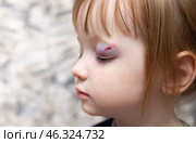Bruise and swelling above the child's eye. Injury to the eyelid from a blow. Accident. Closeup. Soft focus. Стоковое фото, фотограф Дмитрий Кобзев / Фотобанк Лори