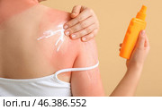 Woman with red sunburned skin applying cream against color background, closeup. Стоковое фото, фотограф Pixel_shot / Фотобанк Лори