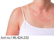 Woman with red sunburned skin against white background, closeup. Стоковое фото, фотограф Pixel_shot / Фотобанк Лори