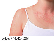 Woman with red sunburned skin against white background, closeup. Стоковое фото, фотограф Pixel_shot / Фотобанк Лори