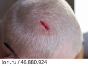 Injury to the scalp. Blood leaks from a chopped wound on the head of a blond man due to falling metal reinforcement. Non-observance of safety precautions. Стоковое фото, фотограф Коханова Наталья / Фотобанк Лори