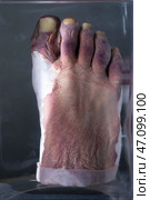 April 1, 2023. Belarus, Minsk. Exhibition of anatomical exhibits. The frostbitten part of a human leg is presented as an anatomical exhibit preserved in alcohol in a formaldehyde solution.Museum exhibit. Редакционное фото, фотограф Лазаренко Светлана / Фотобанк Лори