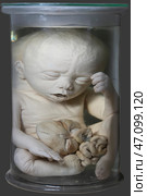 April 1, 2023. Belarus, Minsk. Exhibition of anatomical exhibits. Human infant with pathological development of microcephaly. Human dwarf. Achondroplasia. Редакционное фото, фотограф Лазаренко Светлана / Фотобанк Лори
