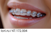 Close up of beautiful female teeth with dental braces. Dentistry concept. Крупный план красивых женских зубов с брекетами. Концепция стоматологии. Стоковое AI-изображение, AI-художник Katsiaryna Repich / Фотобанк Лори