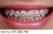 Young person smiling with braces adorned with clear gems in close-up. брекеты. Яркая улыбка демонстрирует ровные зубы, укрепленные серебряными брекетами со сверкающими прозрачными драгоценными камнями. Основное внимание уделяется эстетике зубов, демонстрации ортодонтической работы и личной уверенности. Стоковое AI-изображение, AI-художник Katsiaryna Repich / Фотобанк Лори