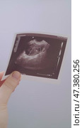 Obstetrician-gynecologist shows ultrasound results to patient, explaining treatment options and supportive methods for conception. Стоковое видео, видеограф Svetlana Golovco / Фотобанк Лори