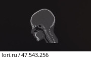 Компьютерная томография головы и шеи человека (КТ). Вид сбоку. Computed tomography of the human head and neck (CT). Side view. Стоковое видео, видеограф Горшков Александр / Фотобанк Лори