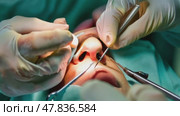 Surgical procedure focusing on nasal reconstruction techniques in a clinical setting. Стоковое AI-видео, аниматор Климов Денис / Фотобанк Лори