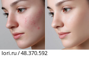 Acne Treatment Before/After, Red Irritated Skin vs. Clear Smooth Complexion. Лечение акне до и после, красная раздраженная кожа против чистой гладкой кожи. Стоковое AI-изображение, AI-художник Katsiaryna Repich / Фотобанк Лори
