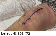 Medical sutures, stitch after surgery, stitched surgical sutures on human body smeared betadine. Medical surgical care. Close-up. Стоковое видео, видеограф Ирина Старикова / Фотобанк Лори