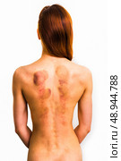 Young woman with marks from cupping therapy. Стоковое фото, агентство Ingram Publishing / Фотобанк Лори