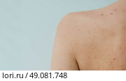 A close-up of a panoramic shot of a woman's skin prone to acne and other dermatological problems. Стоковое фото, фотограф Корчагина Анастасия / Фотобанк Лори