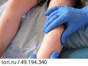 Doctor examining child with bodily red rash. Kid allergy closeup. Little baby scratches an eruption. Nurse applies special cream to atopic skin. Dermatitis, irritation, hive. Pruritus. Mosquito bites. Стоковое фото, фотограф Марина Демидюк / Фотобанк Лори