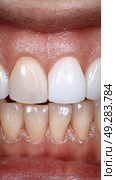 Brightened Teeth After Whitening Treatment Showcasing Smooth Enamel and Uniform Color. Стоковое AI-изображение, AI-художник Юлия Гапеенко / Фотобанк Лори