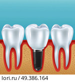 Dental prosthetics realistic vector illustration with healthy teeth and denture crown implanted with implants . dental implant realistic illustration. Стоковая иллюстрация, агентство Ingram Publishing / Фотобанк Лори