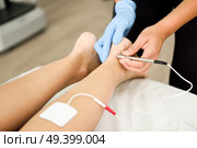 Electroacupuncture dry with needle connecting machine used by acupunturist on female patient for acupuncture guided by EPI Intratissue Percutaneous Electrolisis. Electro stimulation in physical therapy to ankle of a young woman in physiotherapy center. Стоковое фото, агентство Ingram Publishing / Фотобанк Лори