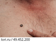 Keratinizing squamous cell carcinoma of the skin of an elderly man. Стоковое фото, фотограф Корчагина Анастасия / Фотобанк Лори