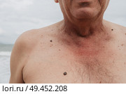 Keratinizing squamous cell carcinoma of the skin of an elderly man. Стоковое фото, фотограф Корчагина Анастасия / Фотобанк Лори