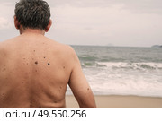 The back of an elderly man with freckles, aging spots, black, brown warts and wrinkles against the background of the sea. Стоковое фото, фотограф Корчагина Анастасия / Фотобанк Лори