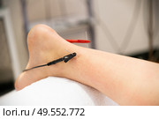 Electro-acupuncture dry with needle connecting machine. Electro stimulation in physical therapy.. Electro acupuncture dry with needle connecting machine. Стоковое фото, агентство Ingram Publishing / Фотобанк Лори