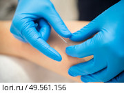 Close-up of a needle and hands of physiotherapist doing a dry needling in a physiotherapy center.. Hands of physiotherapist doing a dry needling. Стоковое фото, агентство Ingram Publishing / Фотобанк Лори