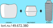 Bolts, screws and crown prosthesis structure. Implantation dentistry, stomatology. Tooth care, treatment, recovery. Dental implant creation scheme. Sequence of connection of screw, abutment and crown. Dental implant scheme, prosthesis structure. Sequence of connection of screw, abutment and crown. Стоковая иллюстрация, агентство Ingram Publishing / Фотобанк Лори