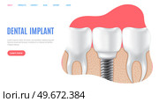 Human jaw with normal teeth and prosthesis above dental implant structure. Tooth after dental procedure. Surgical implant in oral cavity. Treatment, dentistry, oral care. Healthy tooth in human gum. Human jaw with normal healthy teeth and prosthesis in gum above structure of dental implant. Стоковая иллюстрация, агентство Ingram Publishing / Фотобанк Лори