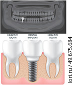 Black and white x-ray of jaw above human gum with normal teeth and dental implant. Tooth after medical procedure, dental treatment. Surgical implant in oral cavity. Radiograph with prosthesis. Black and white x-ray of jaw above human gum with normal healthy teeth and dental implant. Стоковая иллюстрация, агентство Ingram Publishing / Фотобанк Лори