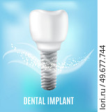 Realistic white dental implant and human tooth. Dentistry, medicine and oral cavity health concept. Denture construction, dental prosthesis structure. Information banner about teeth and implants. Realistic white dental implant and human tooth. Dentistry, medicine and oral cavity health. Стоковая иллюстрация, агентство Ingram Publishing / Фотобанк Лори
