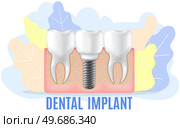 Human jaw with normal teeth and prosthesis above dental implant structure. Tooth after dental procedure. Surgical implant in oral cavity. Treatment, dentistry, oral care. Healthy tooth in human gum. Human jaw with normal healthy teeth and prosthesis in gum above structure of dental implant. Стоковая иллюстрация, агентство Ingram Publishing / Фотобанк Лори