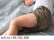 Child scratch body has sensitive itchy skin. Bodily rash. Kid allergy closeup. Little baby scratches eruption. Irritation, hive. Pruritus. Mosquito insect bite. Red from sunburn, Seborrheic Dermatitis. Стоковое фото, фотограф Марина Демидюк / Фотобанк Лори
