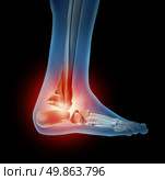 Ankle foot pain with a skeleton of the walking body part with bones in red where there is inflammation of the side view joint that has an orthopedic joint injury caused by bad shoes or running accident. Стоковое фото, агентство Ingram Publishing / Фотобанк Лори