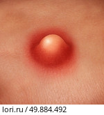 Pimple on human skin as a medical and dermatology health care concept with a blocked pore causing a whitehead red inflamation with bacterial or virus infection. Стоковое фото, агентство Ingram Publishing / Фотобанк Лори