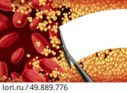 Blood cleansing a clogged artery with a wiper cleaning cholesterol plaque as an arteriosclerosis health risk therapy and cardiovascular treatment concept. Стоковое фото, агентство Ingram Publishing / Фотобанк Лори