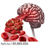 Brain blood clot medical concept as 3D illustration blood cells blocked by an artery blockage thrombus causing a blockage of blood flow to the neurology anatomy. Стоковое фото, агентство Ingram Publishing / Фотобанк Лори