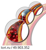Angioplasty and stent concept as a heart disease treatment symbol diagram with the stages of an implant procedure in an artery that has cholesterol plaque blockage being opened for increased blood flow as a 3D illustration. Стоковое фото, агентство Ingram Publishing / Фотобанк Лори